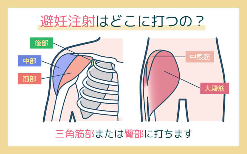 避妊注射を打つ部位